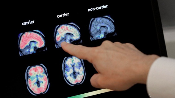 تحقیقات جدید نشان می دهد مدل هوش مصنوعی می تواند بیماری آلزایمر را با دقت بیش از 90 درصد تشخیص دهد.